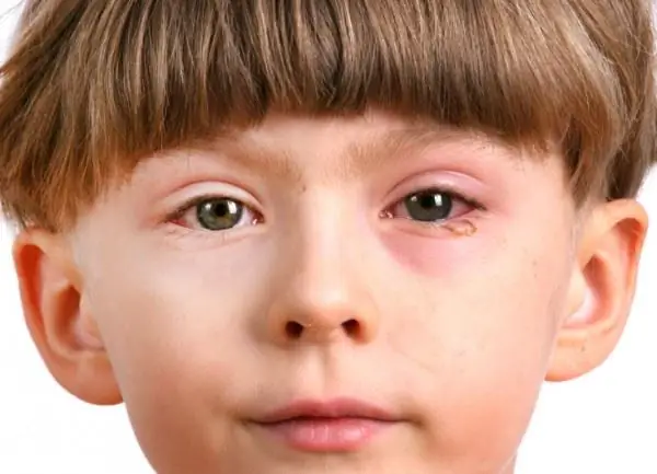 niño con conjuntivitis