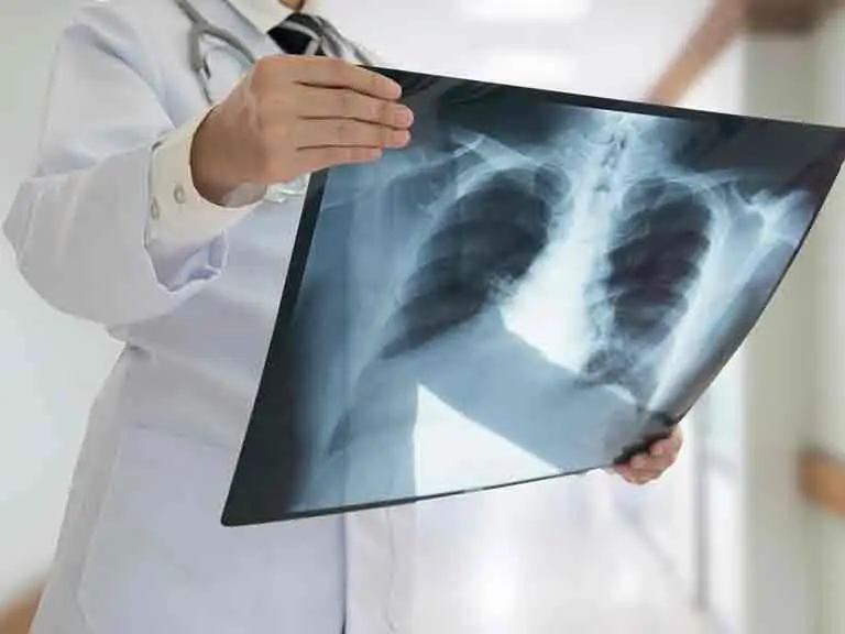 radiographie pulmonaire