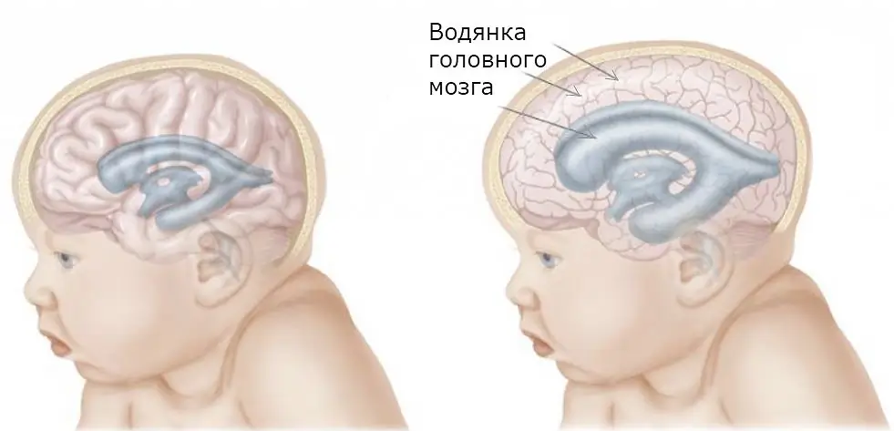 Hidropesía del cerebro en un niño