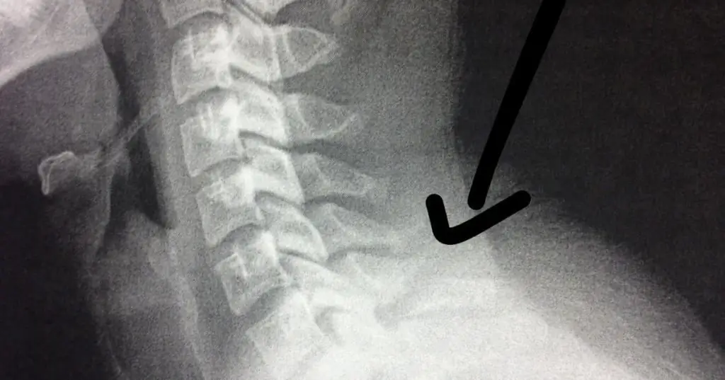 fracture in the lower back