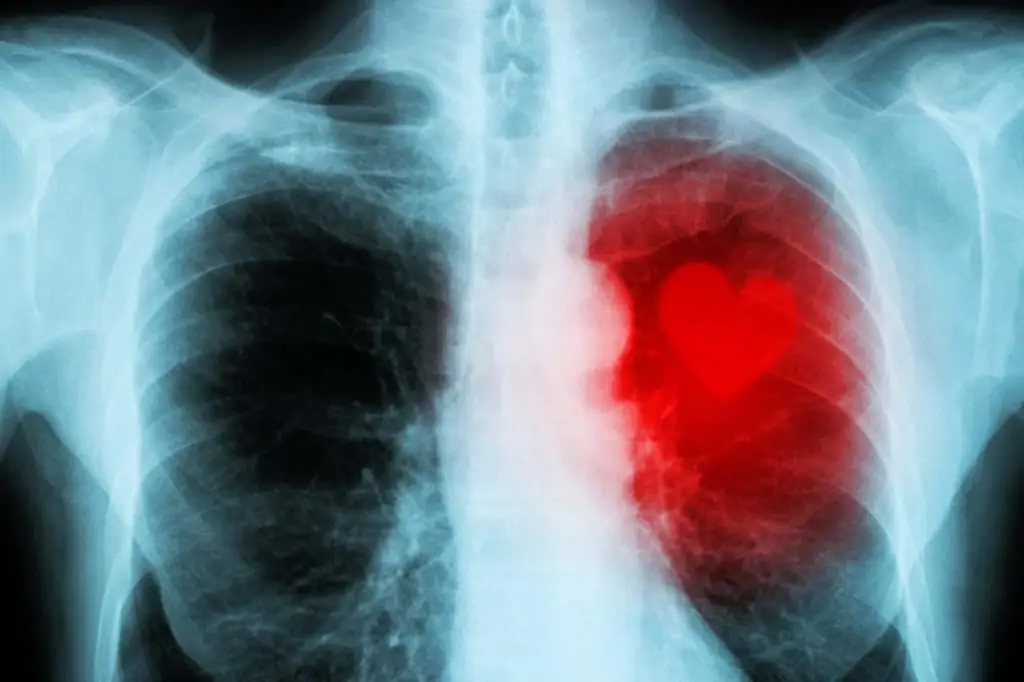 Fluorography shows smoker's diseases