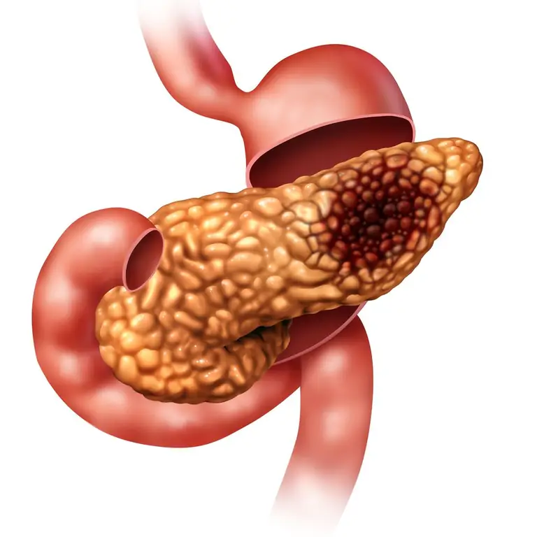 Diseased pancreas