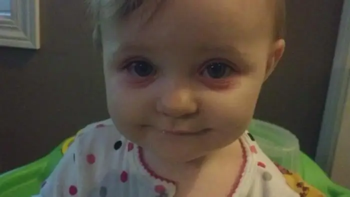 redness under the eyes of a child causes and photo