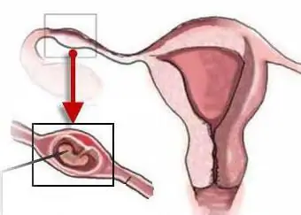 sintomas ng pagbubuntis ng tubal