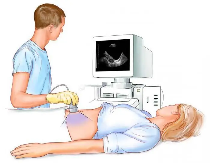 tubal pregnancy tulad ng tubal abortion