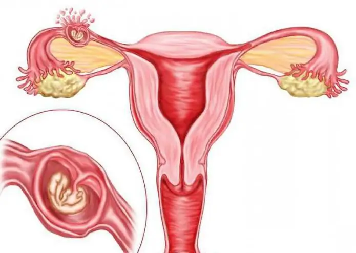 buitenbaarmoederlijke zwangerschap eileiders abortus