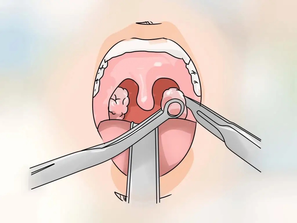 purulent tonsillitis treatment in children