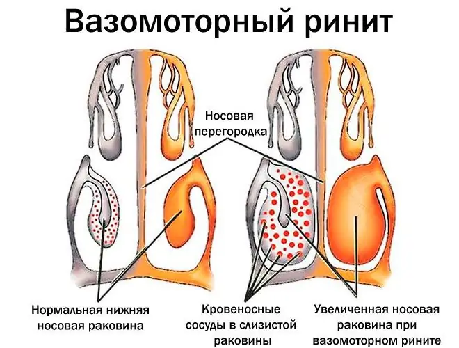 Վազոմոտոր ռինիտ