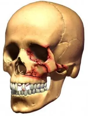 Primeros auxilios para lesiones cerebrales traumáticas