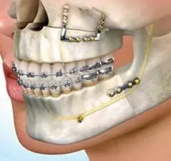 ข้อบ่งชี้ในการทำศัลยกรรมขากรรไกร