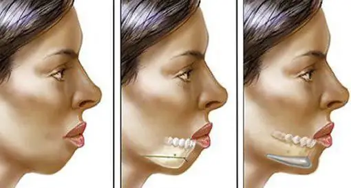 història del desenvolupament de la cirurgia ortognàtica