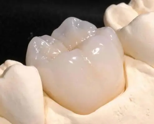 Zirconia inlay