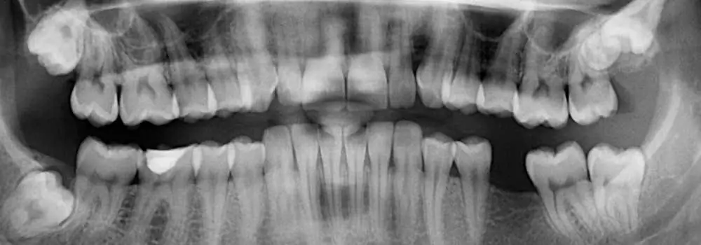 o que é melhor colocar uma ponte nos dentes