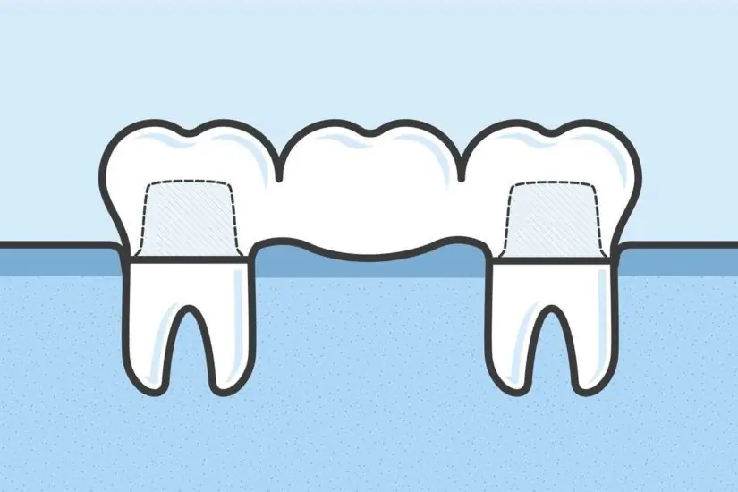 چگونه بریج را روی دندان خود قرار دهیم عکس