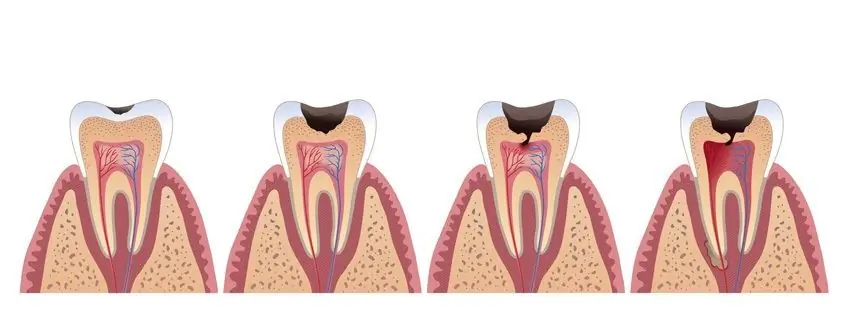 Shfaqja e kariesit dentar