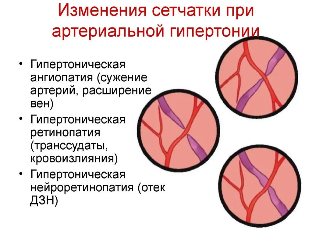 Гипертония кезіндегі көз түбі – өзгерістер түрлері