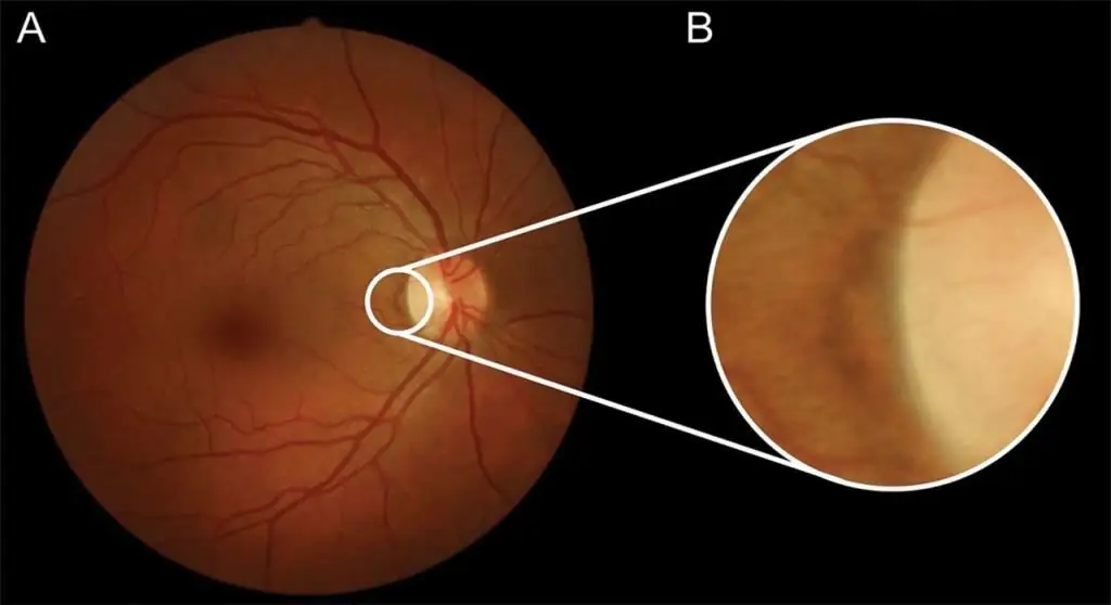 Fundus i øyet ved hypertensjon - oftalmoskopi