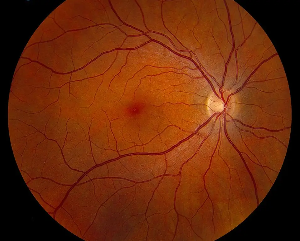 Die fundus van die oog in hipertensie - die fundus van die oog in 'n gesonde persoon