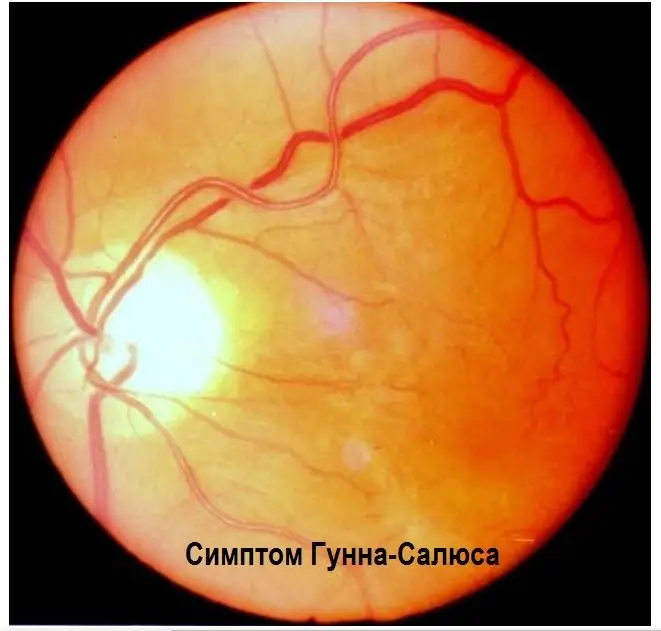 Fundus i øyet ved hypertensjon - et symptom på Gunn-Salus