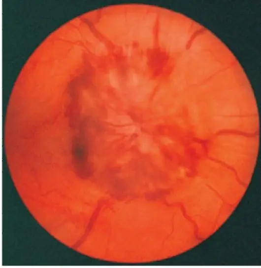 Ögats fundus vid högt blodtryck - ödem i den optiska skivan