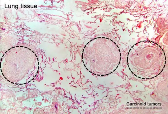 triệu chứng hội chứng carcinoid