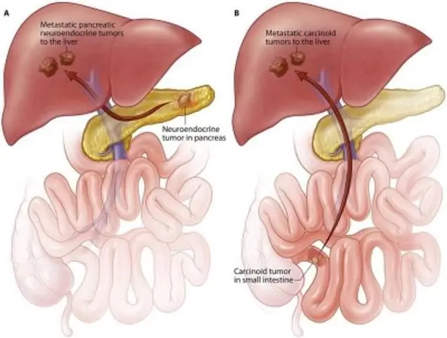 carcinoid syndrom og carcinoid tumor