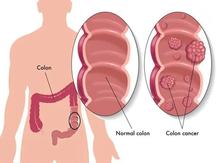 carcinoid syndrome คืออะไร