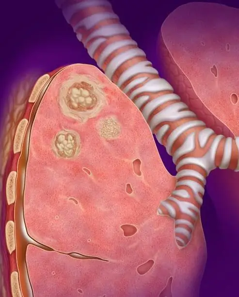 pneumonia caseous