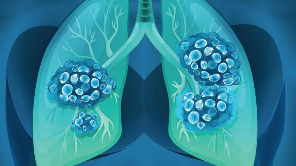 grades of lung cancer