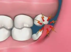 indicacions per a l'extracció de dents