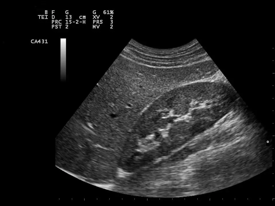 What does a kidney look like on an ultrasound?