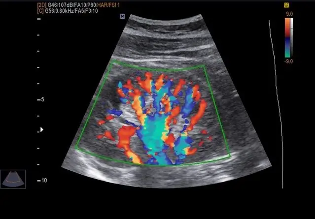 Duplex (Doppler) study of the kidneys