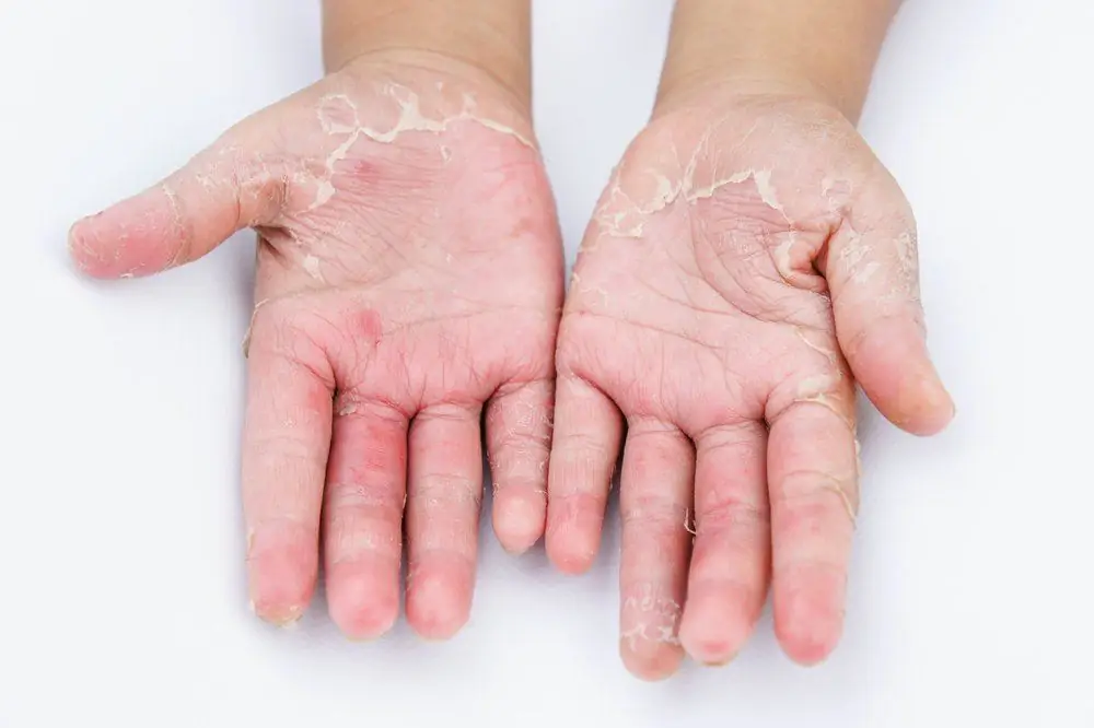 Diagnosis ng contact dermatitis