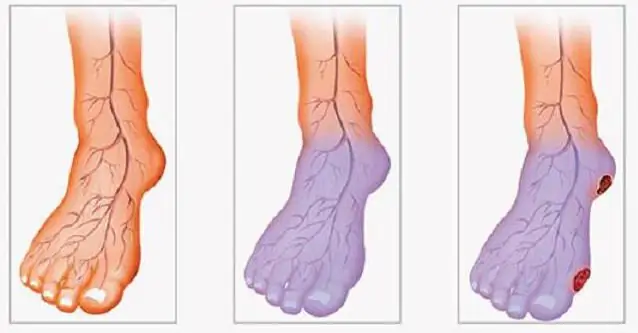 stenosing atherosclerosis of the lower extremities