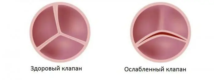 tricuspid aortic valve