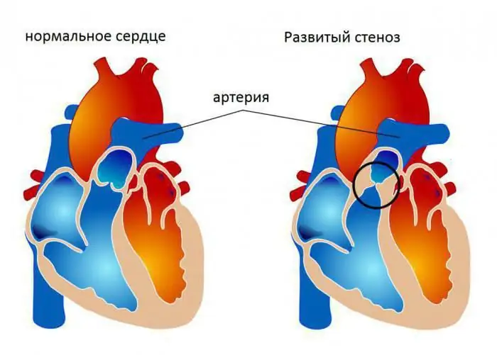 tricuspid valve is