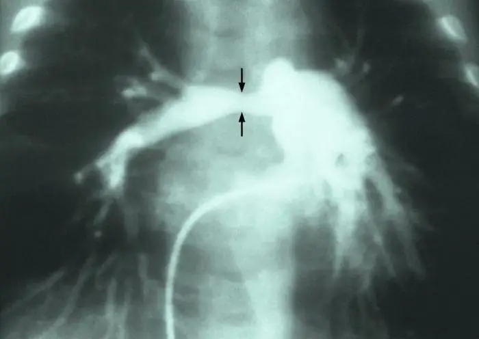 tricuspid valve stenosis