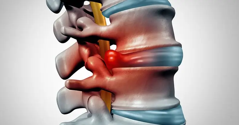 Formation of a hernia in the lumbar region