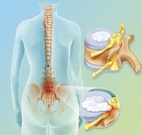 removal of the intervertebral hernia of the lumbar