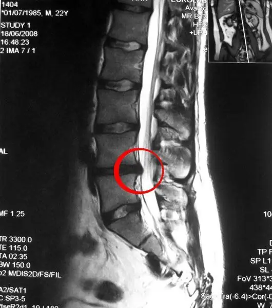 Cov tsos mob ntawm lumbar disc herniation