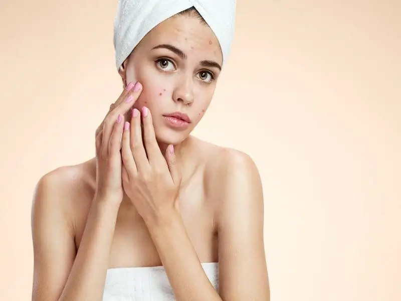 acne treatment and prevention