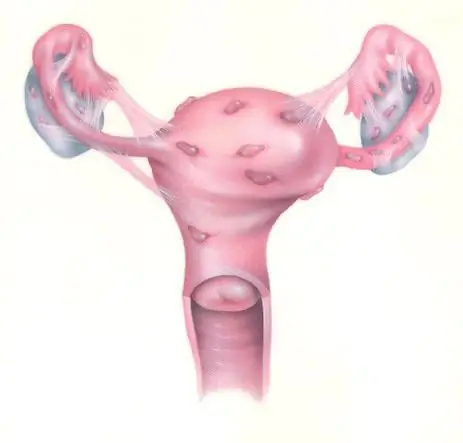 extragenitální endometrióza