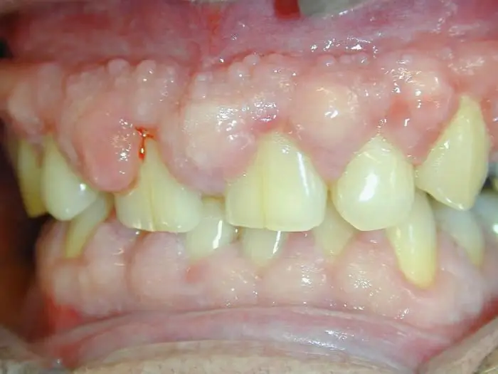 fibromatose gengival