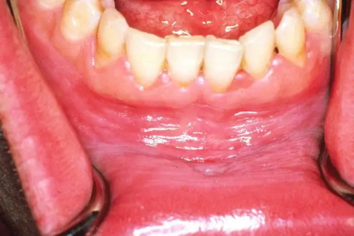 swollen gums treatment