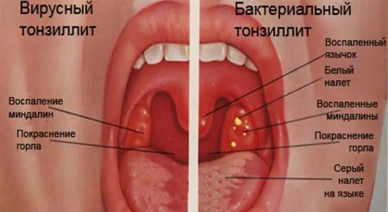 Вирустық және бактериялық тонзиллит