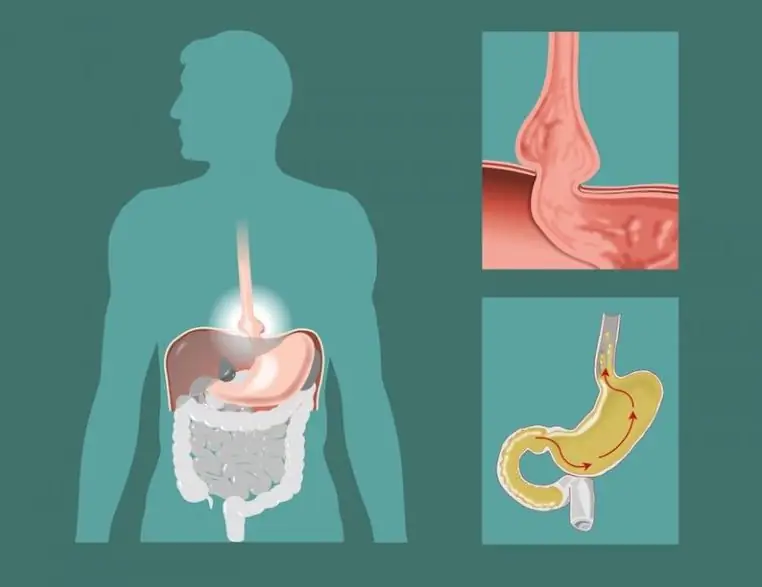 Hernia formation