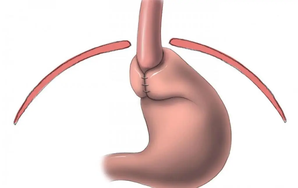 resultado de la cirugia