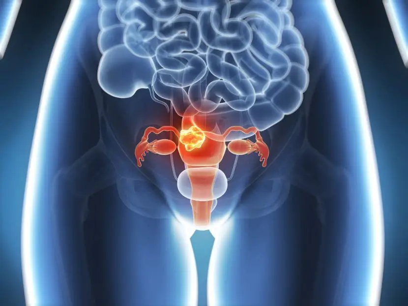 Inflammation of the uterus