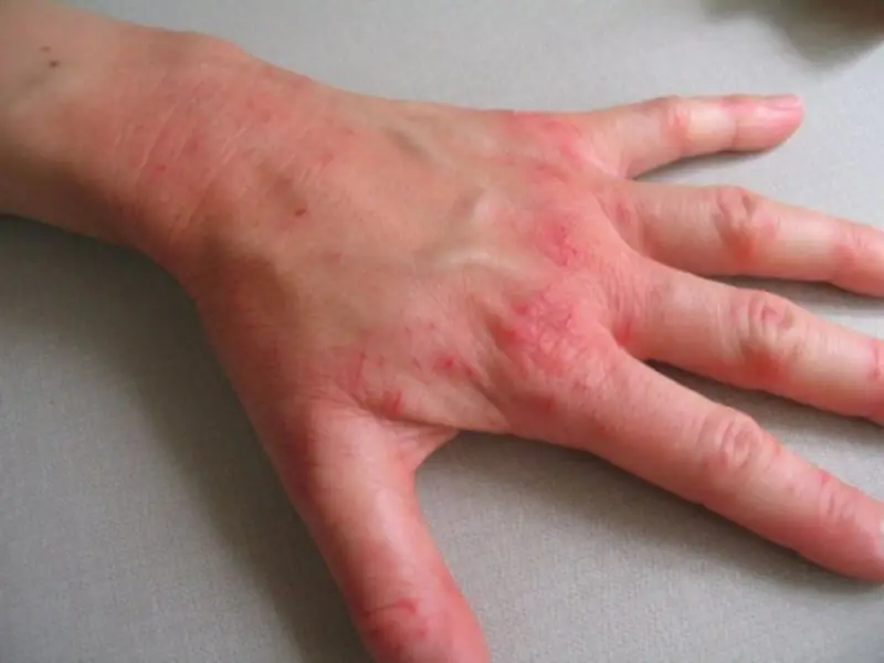 Dyshidrotic Eczema Photos Symptoms And Treatment Diseases And 
