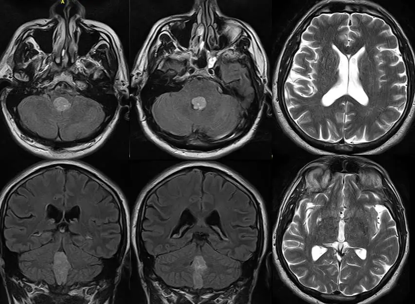 CT-Scan eines Mannes mit einem Tumor